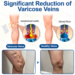 Varicose Vein Microneedle Pain Relief Patch